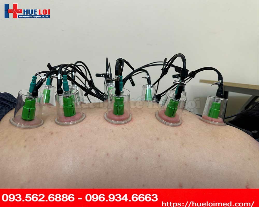 Máy điện châm không kim kết hợp điện xung